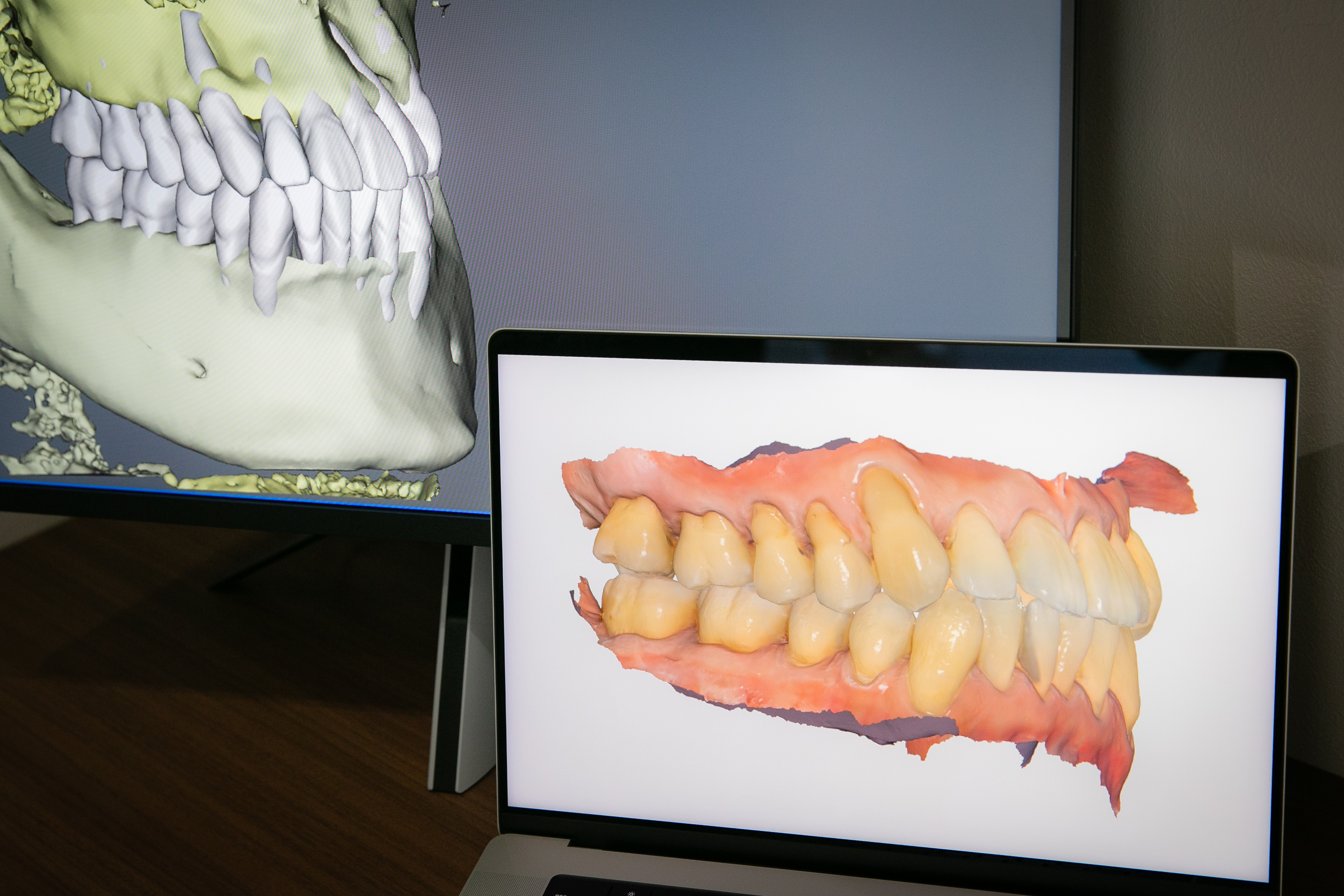 口腔内スキャナーとCTを組み合わせた矯正診断